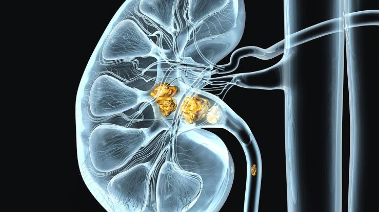 Kidney Stone