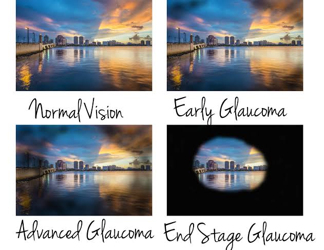 Glaucoma: silent thief of&nbsp;Sight