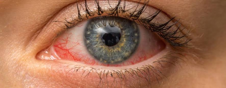 Conjunctivitis